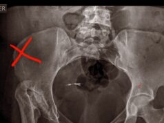 Venden rifa para costear operación de Endoprotesis total de cadera