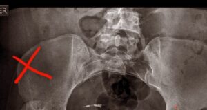 Venden rifa para costear operación de Endoprotesis total de cadera