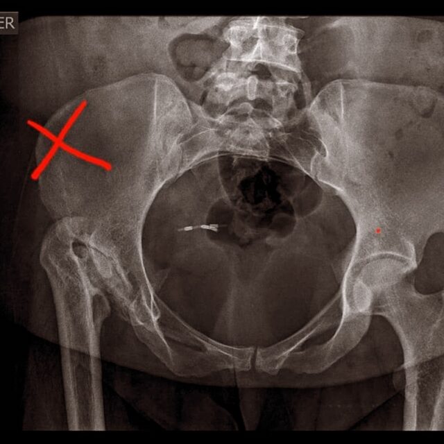 Venden rifa para costear operación de Endoprotesis total de cadera