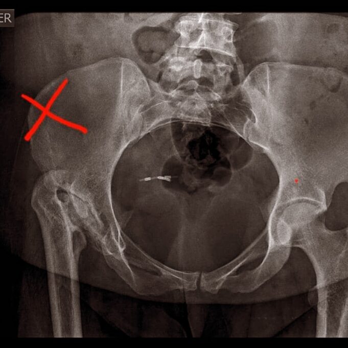 Venden rifa para costear operación de Endoprotesis total de cadera