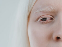 Columna: El albinismo, una mirada desde las alteraciones visuales