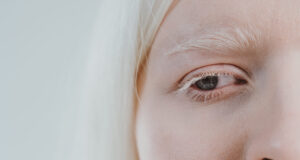 Columna: El albinismo, una mirada desde las alteraciones visuales