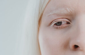 Columna: El albinismo, una mirada desde las alteraciones visuales