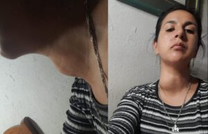 Mujer de Freire busca reunir $6 millones para urgente cirugía por nódulo que afecta su respiración