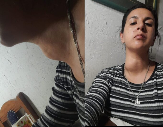 Mujer de Freire busca reunir $6 millones para urgente cirugía por nódulo que afecta su respiración