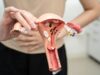 Cáncer de ovario: 7 de cada 10 casos se detectan tarde