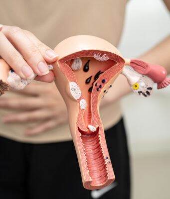 Cáncer de ovario: 7 de cada 10 casos se detectan tarde