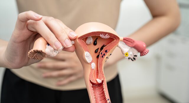 Cáncer de ovario: 7 de cada 10 casos se detectan tarde