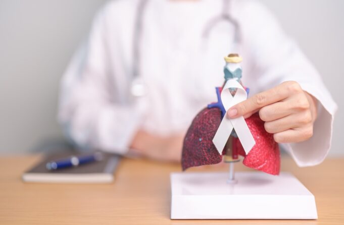 Cáncer de pulmón: la enfermedad que provoca 10 muertes diarias en Chile y que en más del 80% de los casos se detecta tarde